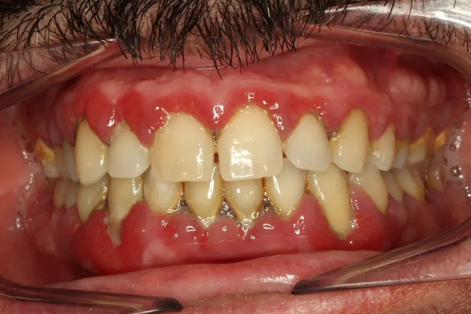 cirugia-periodontal Tratamientos de odontología y saneamiento bucal