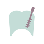 Tratamientos dentales de endodoncia