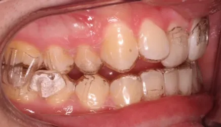 Dientes con tratamientos dentales de ortodoncia invisible