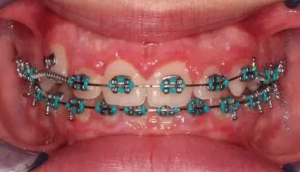 Dientes con tratamientos dentales de ortodoncia visible