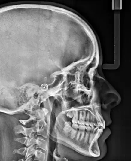 Resultado de un diagnóstico 3D de una persona de perfil