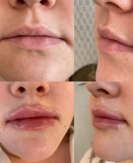tratamientos-8 Paciente antes y después del tratamiento de ácido hialurónico en los labios.