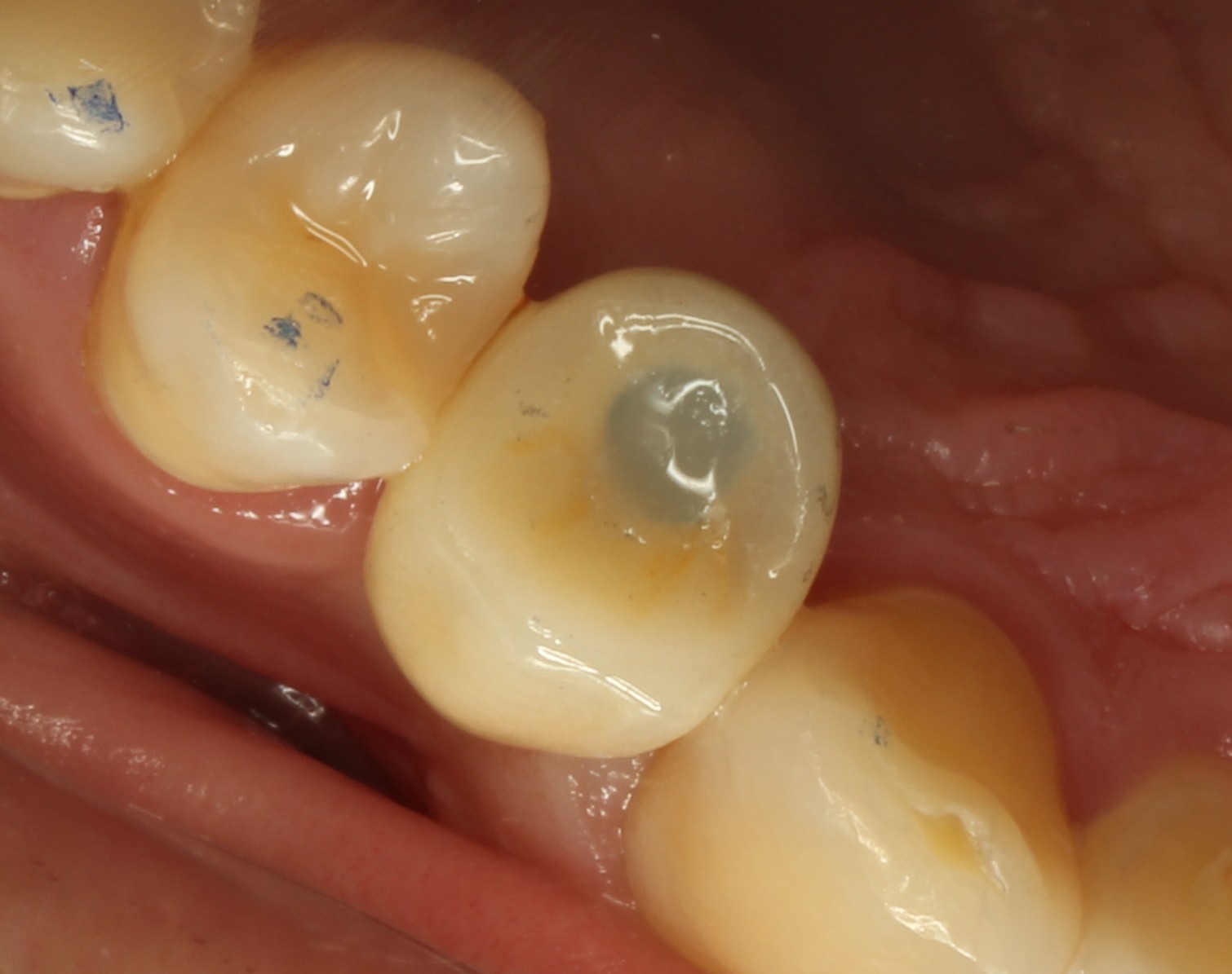 img-implantes-1
